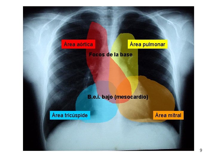 Área aórtica Área pulmonar Focos de la base B. e. i. bajo (mesocardio) Área