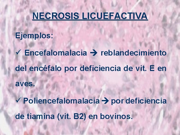 NECROSIS LICUEFACTIVA Ejemplos: ü Encefalomalacia reblandecimiento del encéfalo por deficiencia de vit. E en