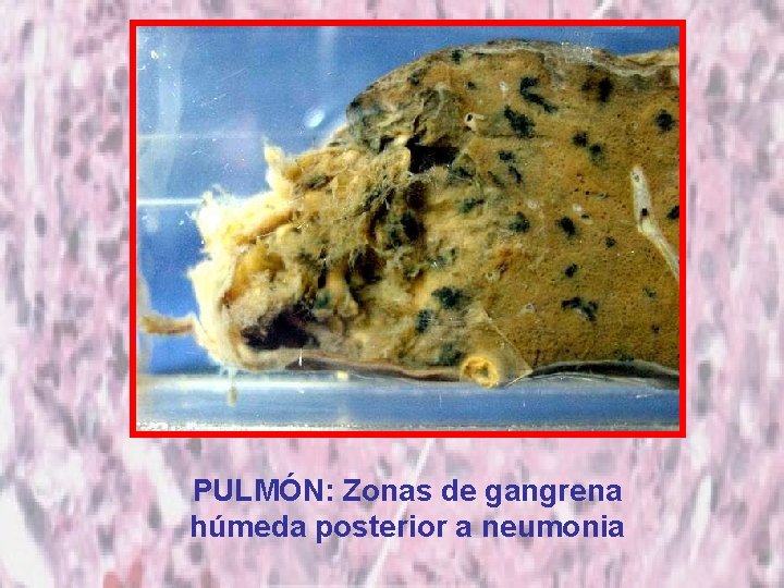 PULMÓN: Zonas de gangrena húmeda posterior a neumonia 