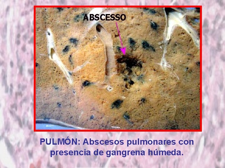 PULMÓN: Abscesos pulmonares con presencia de gangrena húmeda. 