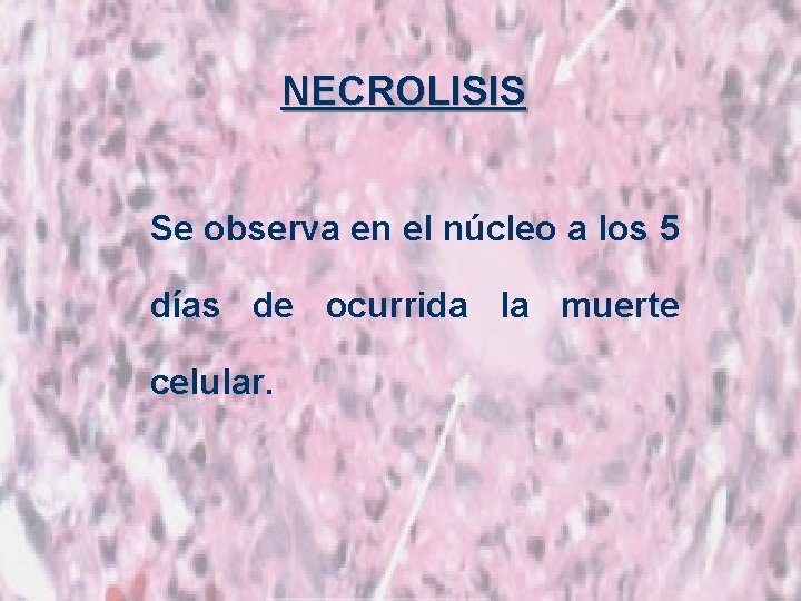 NECROLISIS Se observa en el núcleo a los 5 días de ocurrida la muerte