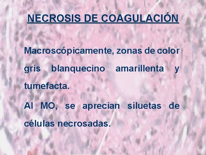 NECROSIS DE COAGULACIÓN Macroscópicamente, zonas de color gris blanquecino amarillenta y tumefacta. Al MO,