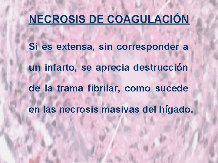 NECROSIS DE COAGULACIÓN Si es extensa, sin corresponder a un infarto, se aprecia destrucción