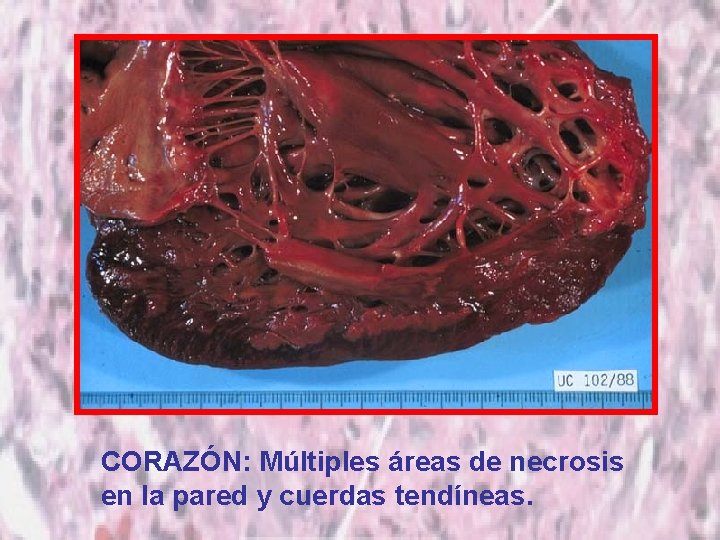 CORAZÓN: Múltiples áreas de necrosis en la pared y cuerdas tendíneas. 