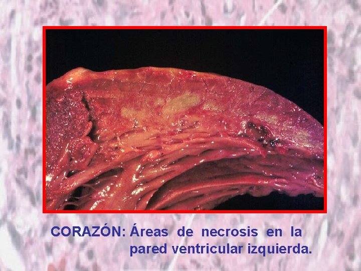 CORAZÓN: Áreas de necrosis en la pared ventricular izquierda. 