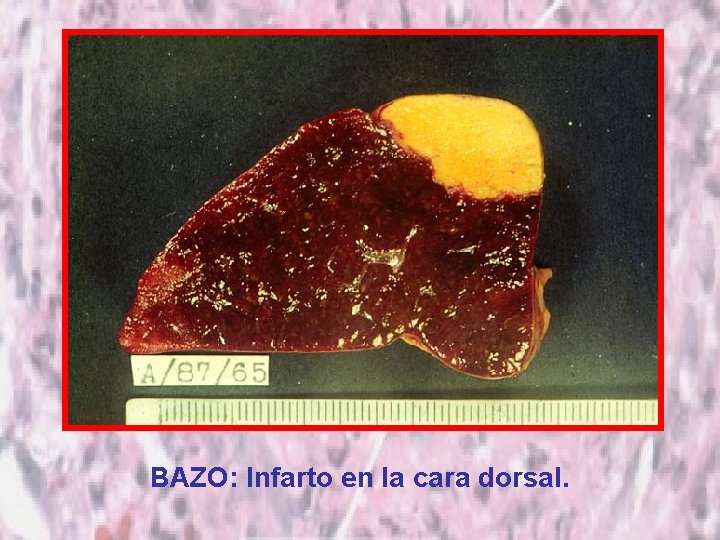 BAZO: Infarto en la cara dorsal. 