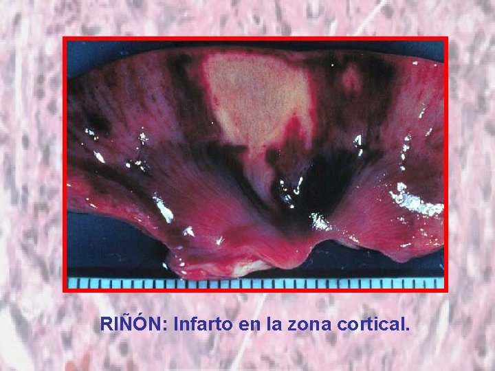 RIÑÓN: Infarto en la zona cortical. 