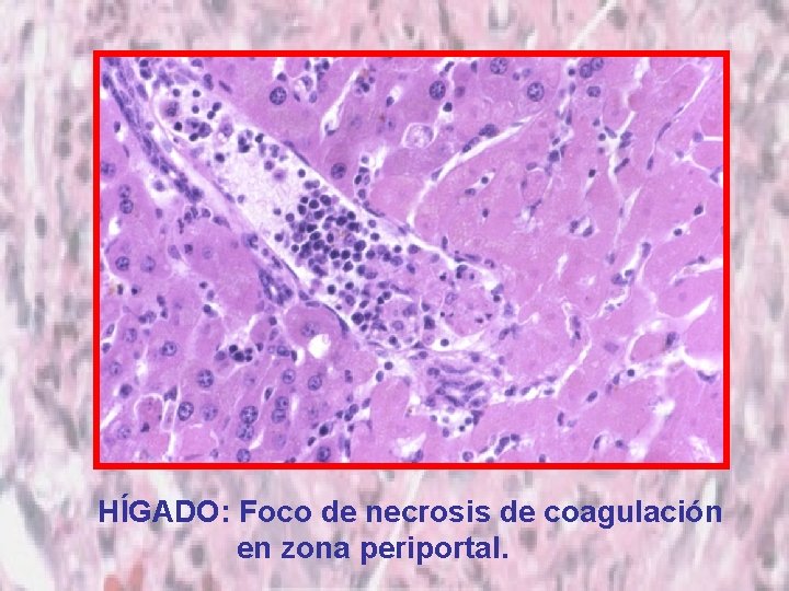 HÍGADO: Foco de necrosis de coagulación en zona periportal. 