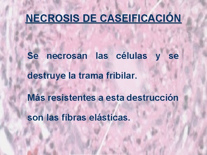 NECROSIS DE CASEIFICACIÓN Se necrosan las células y se destruye la trama fribilar. Más