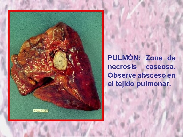 PULMÓN: Zona de necrosis caseosa. Observe absceso en el tejido pulmonar. 