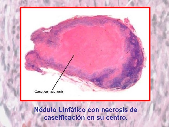 Nódulo Linfático con necrosis de caseificación en su centro. 