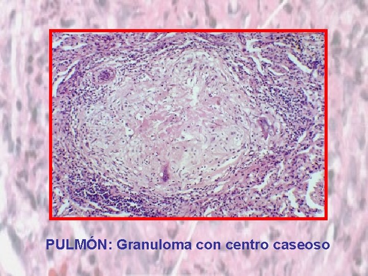 PULMÓN: Granuloma con centro caseoso 