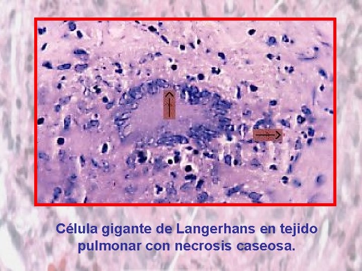 Célula gigante de Langerhans en tejido pulmonar con necrosis caseosa. 