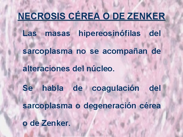 NECROSIS CÉREA O DE ZENKER Las masas hipereosinófilas del sarcoplasma no se acompañan de