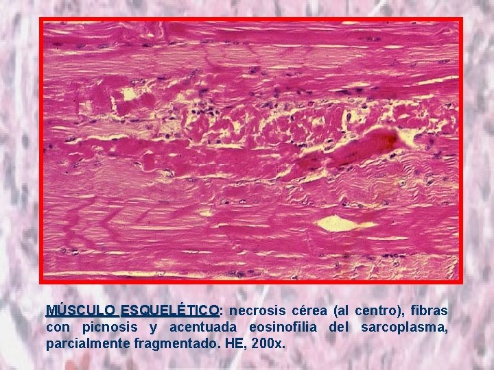 MÚSCULO ESQUELÉTICO: ESQUELÉTICO necrosis cérea (al centro), fibras con picnosis y acentuada eosinofilia del