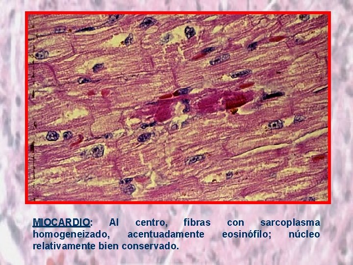 MIOCARDIO: Al centro, fibras MIOCARDIO homogeneizado, acentuadamente relativamente bien conservado. con sarcoplasma eosinófilo; núcleo