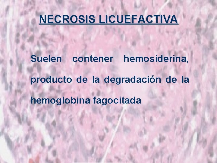 NECROSIS LICUEFACTIVA Suelen contener hemosiderina, producto de la degradación de la hemoglobina fagocitada 