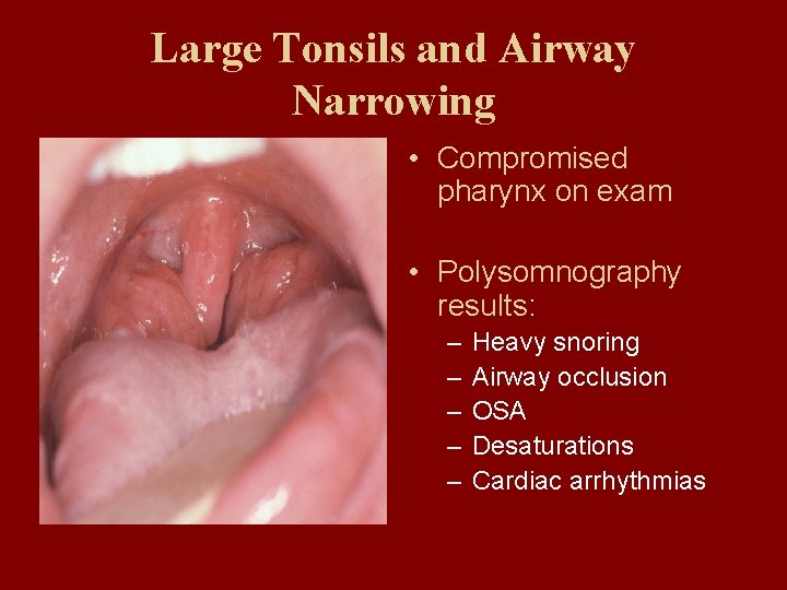 Large Tonsils and Airway Narrowing • Compromised pharynx on exam • Polysomnography results: –