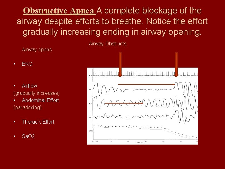Obstructive Apnea A complete blockage of the airway despite efforts to breathe. Notice the