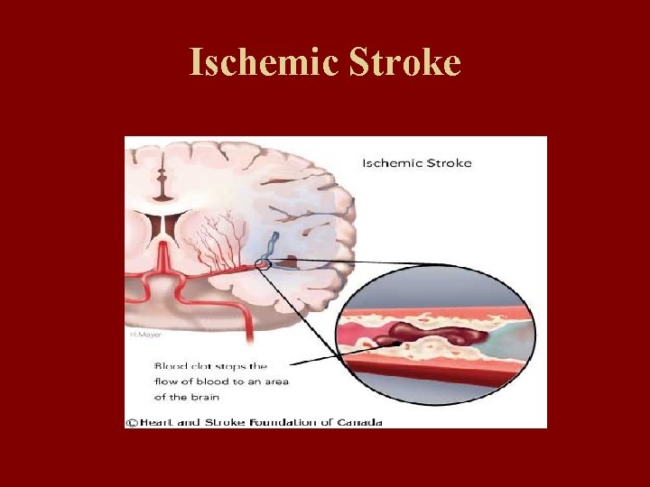 Ischemic Stroke 