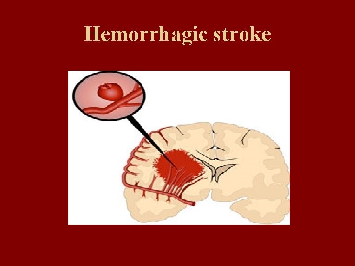 Hemorrhagic stroke 