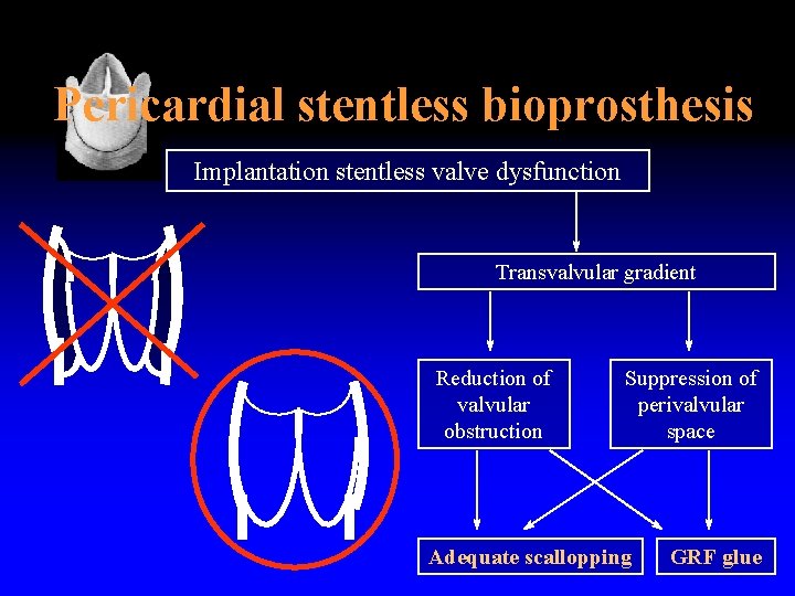 Pericardial stentless bioprosthesis Implantation stentless valve dysfunction Transvalvular gradient Reduction of valvular obstruction Suppression