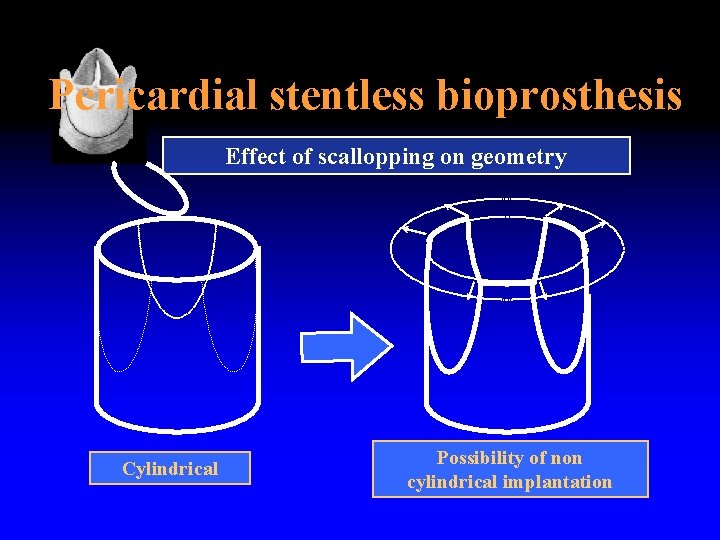 Pericardial stentless bioprosthesis Effect of scallopping on geometry Cylindrical Possibility of non cylindrical implantation
