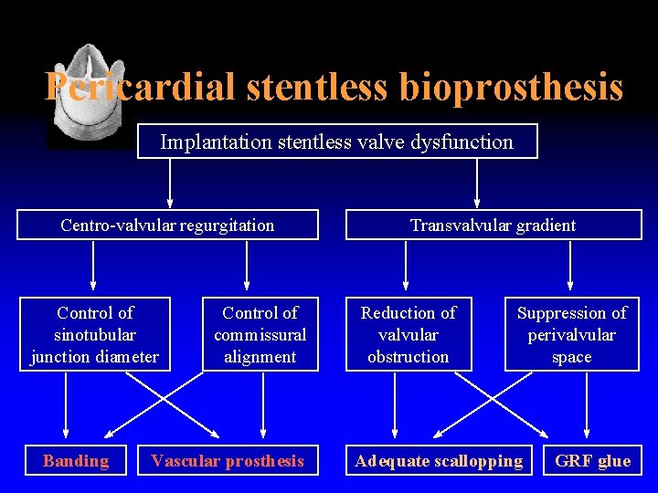 Pericardial stentless bioprosthesis Implantation stentless valve dysfunction Centro-valvular regurgitation Control of sinotubular junction diameter