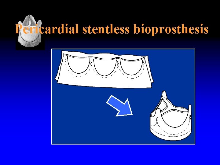 Pericardial stentless bioprosthesis 