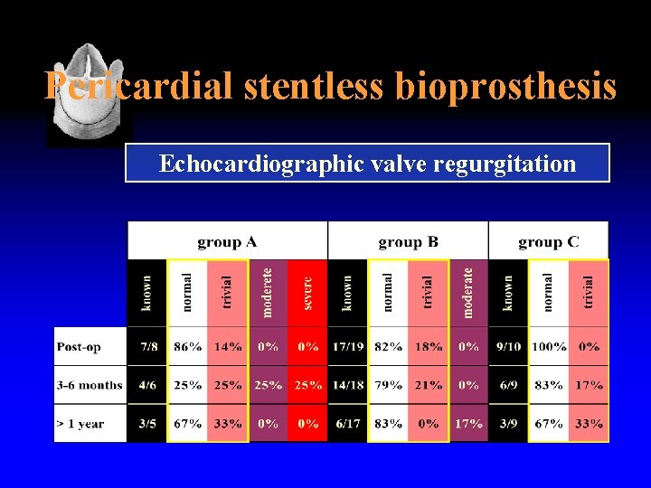 Pericardial stentless bioprosthesis Echocardiographic valve regurgitation 