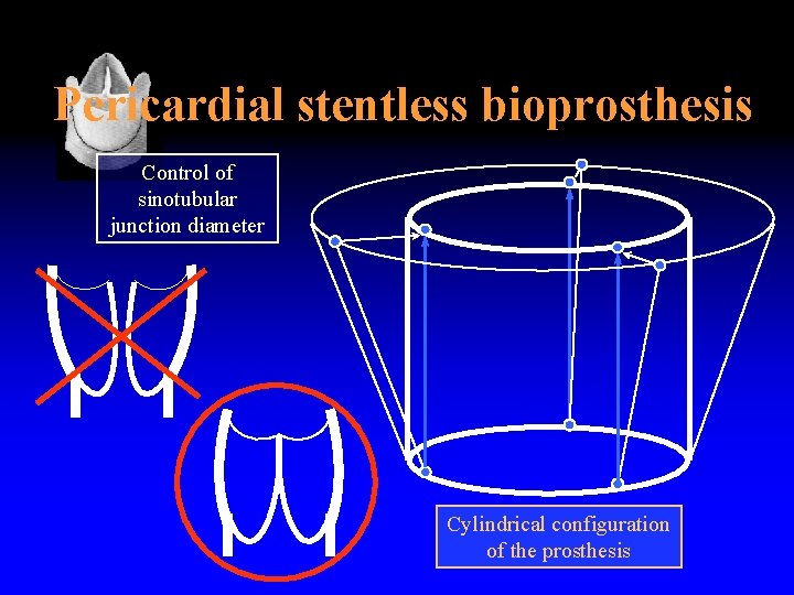 Pericardial stentless bioprosthesis Control of sinotubular junction diameter Cylindrical configuration of the prosthesis 