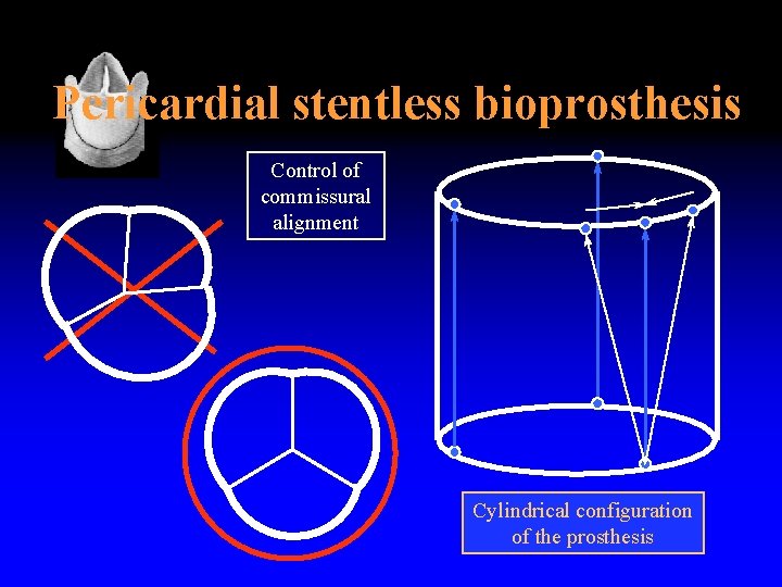 Pericardial stentless bioprosthesis Control of commissural alignment Cylindrical configuration of the prosthesis 