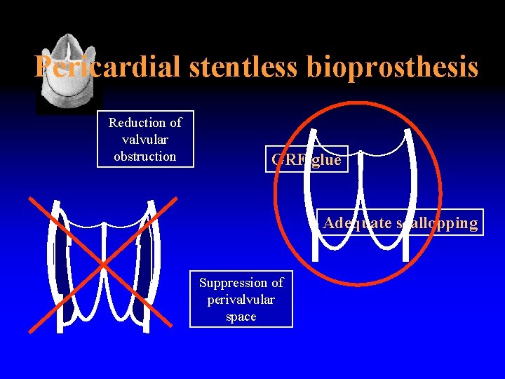 Pericardial stentless bioprosthesis Reduction of valvular obstruction GRF glue Adequate scallopping Suppression of perivalvular