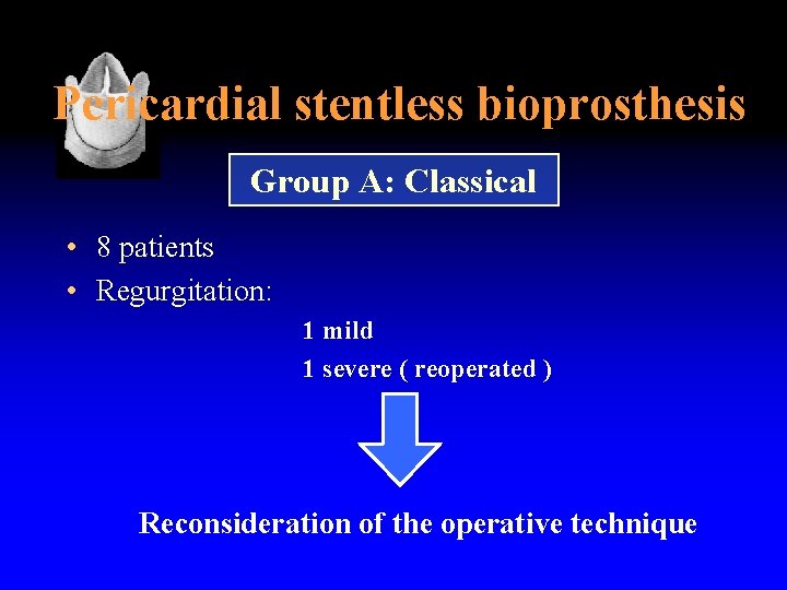 Pericardial stentless bioprosthesis Group A: Classical • 8 patients • Regurgitation: 1 mild 1