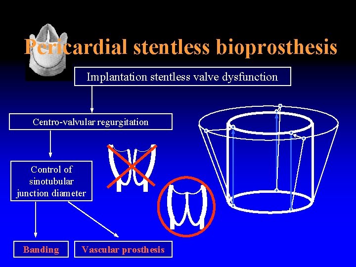 Pericardial stentless bioprosthesis Implantation stentless valve dysfunction Centro-valvular regurgitation Control of sinotubular junction diameter