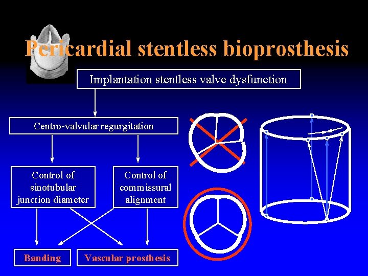 Pericardial stentless bioprosthesis Implantation stentless valve dysfunction Centro-valvular regurgitation Control of sinotubular junction diameter