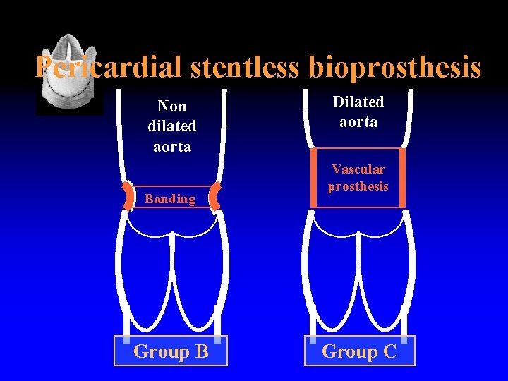 Pericardial stentless bioprosthesis Non dilated aorta Banding Group B Dilated aorta Vascular prosthesis Group