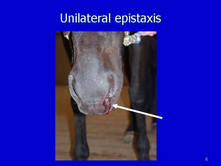Unilateral epistaxis 6 