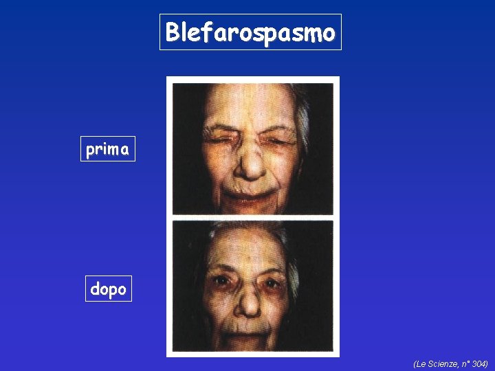 Blefarospasmo prima dopo (Le Scienze, n° 304) 