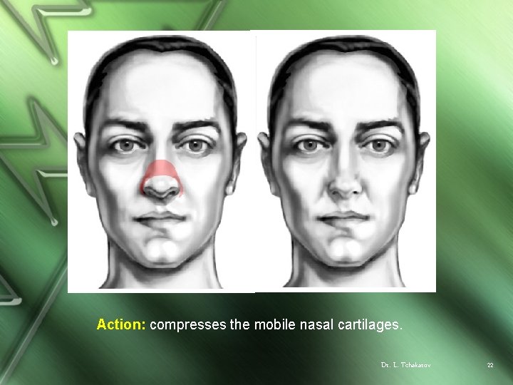 Action: compresses the mobile nasal cartilages. Dr. L. Tchakarov 22 