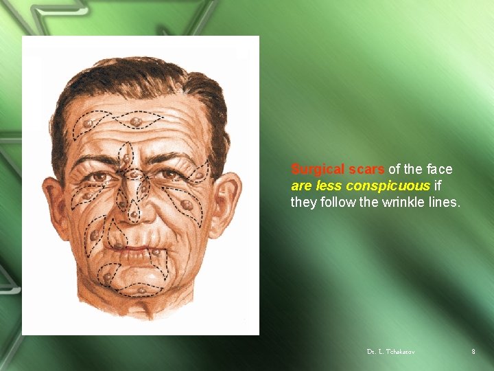 Surgical scars of the face are less conspicuous if they follow the wrinkle lines.