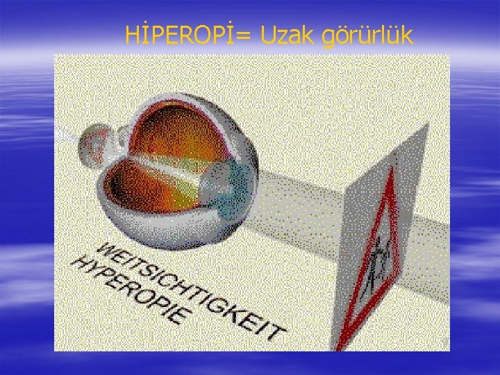 HİPEROPİ= Uzak görürlük 