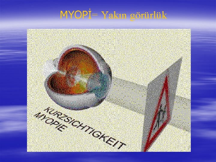 MYOPİ= Yakın görürlük 