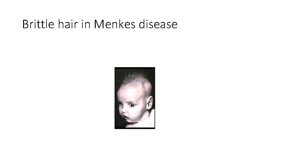 Brittle hair in Menkes disease 