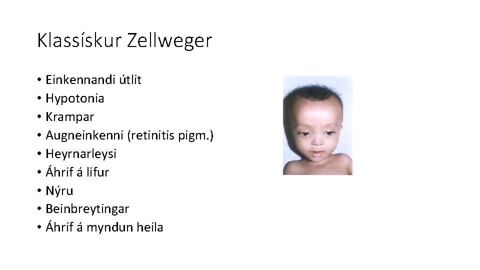 Klassískur Zellweger • Einkennandi útlit • Hypotonia • Krampar • Augneinkenni (retinitis pigm. )