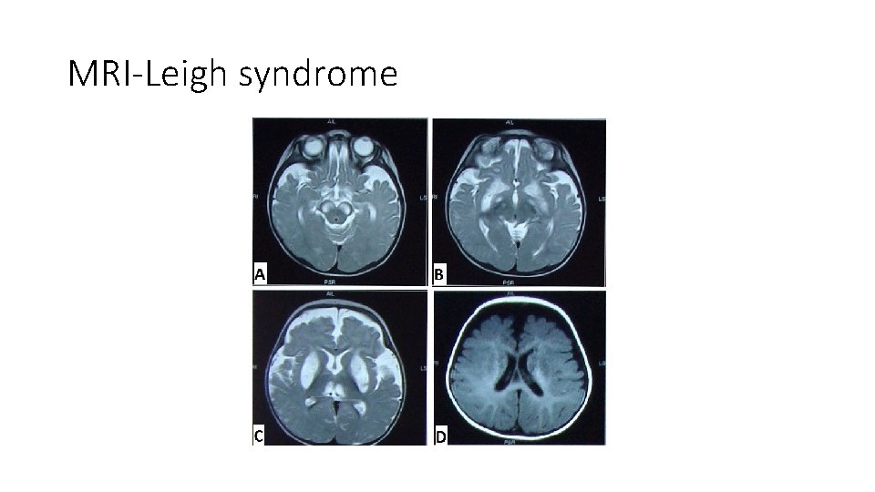 MRI-Leigh syndrome 