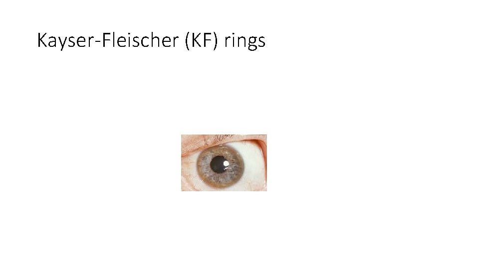 Kayser-Fleischer (KF) rings 