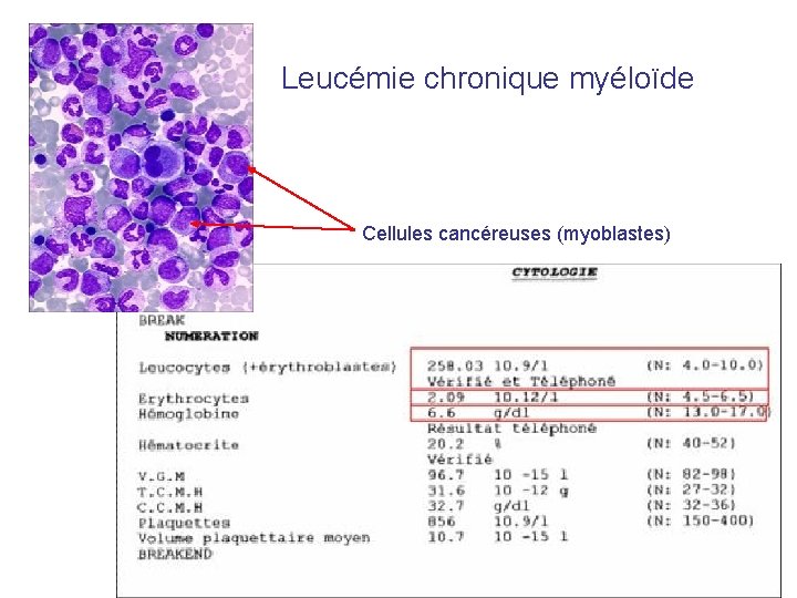 Leucémie chronique myéloïde Cellules cancéreuses (myoblastes) 