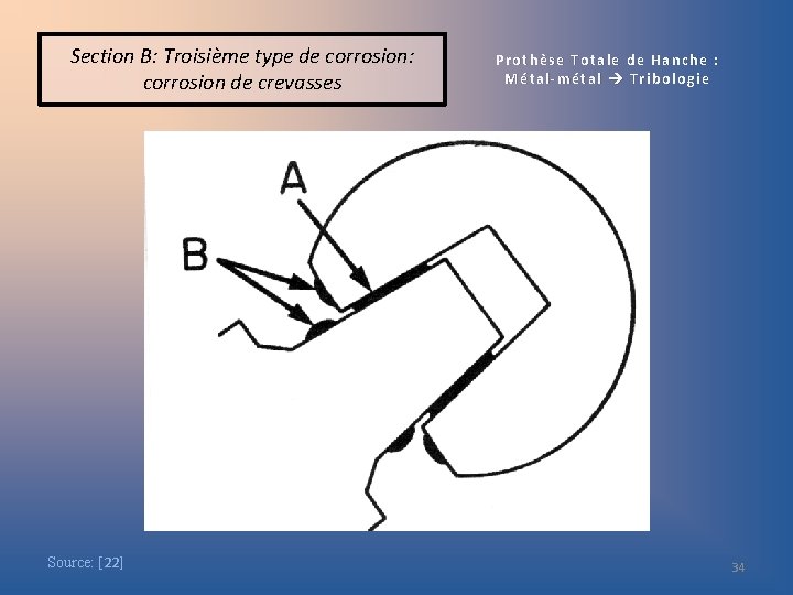 Section B: Troisième type de corrosion: corrosion de crevasses Source: [22] Prothèse Totale de