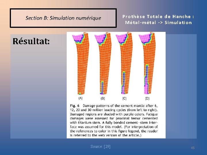 Section B: Simulation numérique Prothèse Totale de Hanche : Métal-métal -> Simulation Résultat: Source: